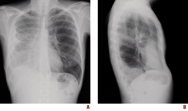 pleural effusion x ray lateral