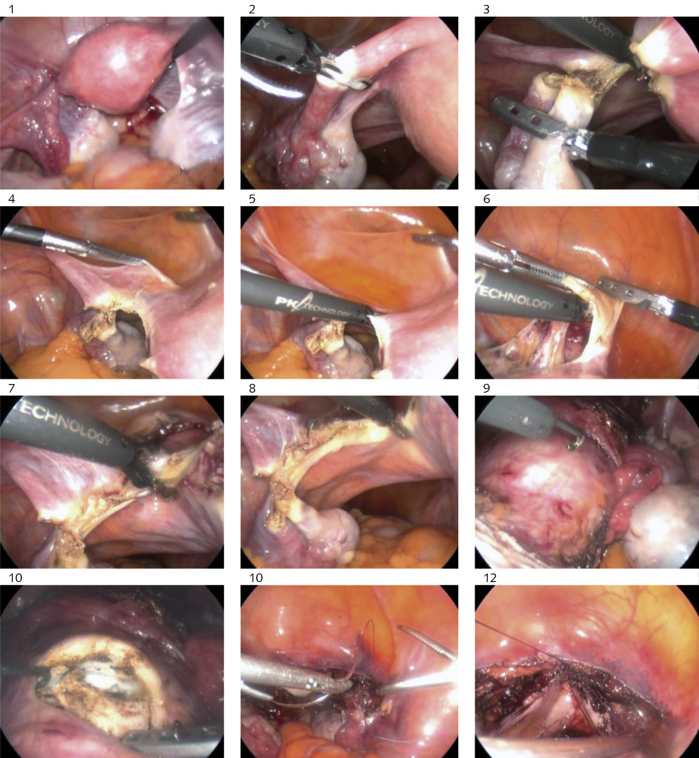 Laparoendoscopic single-site surgery for deep infiltrating