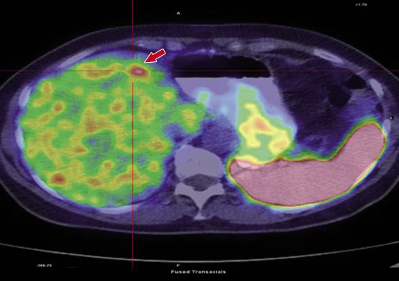 A Primitive Neuroendocrine Liver Tumour Cevenini