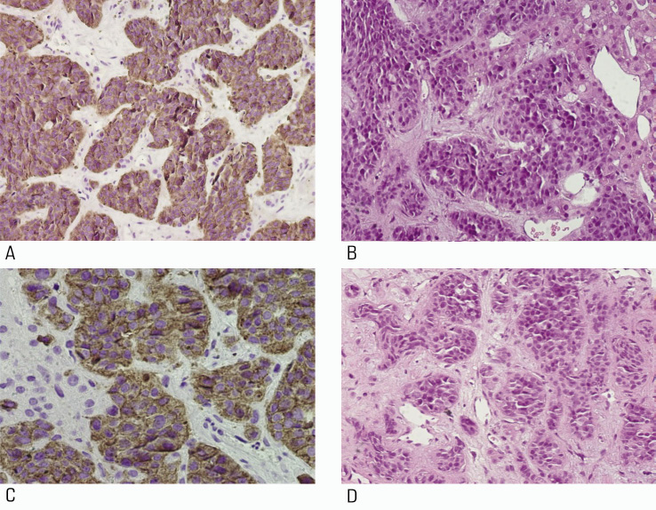 A Case Of Ectopic Acth Secretion Cevenini Clinical